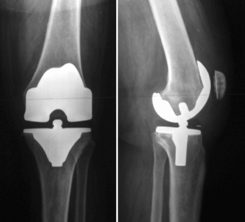 Prótesis De Rodilla Precio Dr Farfán Ortopedista Bogota Colombia